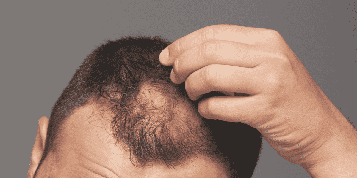problem łysienia androgenowego u mężczyzn